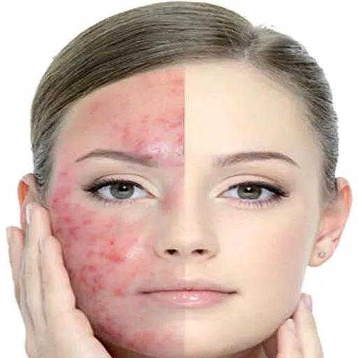 Get Rid of Acne  (Guide) Ekran Görüntüsü 1